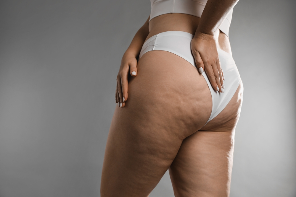 Lipedema